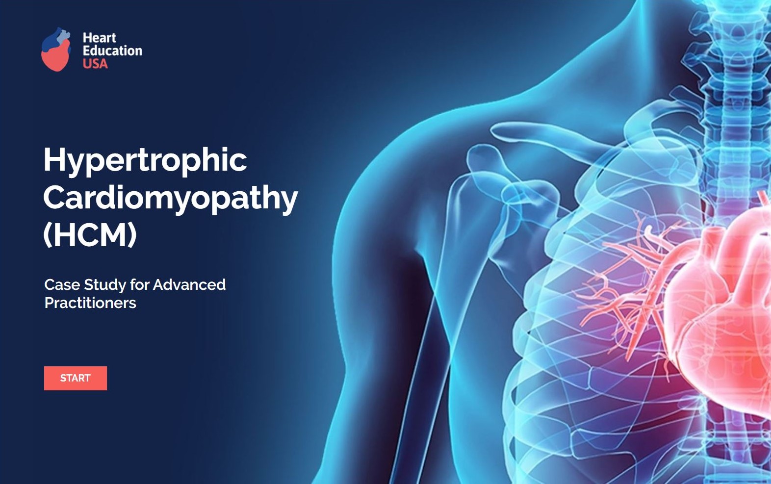 a case study of hypertrophic cardiomyopathy